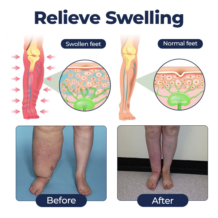 Twisma® SwellRelief krema za podporo prekrvavitvi 👩🏻‍⚕️ POSEBNA RAZPRODAJA – ZADNJI DAN | 80 % POPUST 🔥