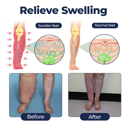 Twisma® SwellRelief krema za podporo prekrvavitvi 👩🏻‍⚕️ POSEBNA RAZPRODAJA – ZADNJI DAN | 80 % POPUST 🔥