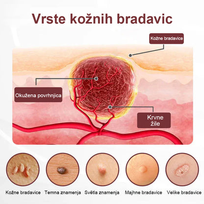✨ Twisma® Crema Pro za odstranjevanje bradavic in madežev 🧑‍⚕️ Hitro olajšanje in vidni rezultati že v samo 2 tednih