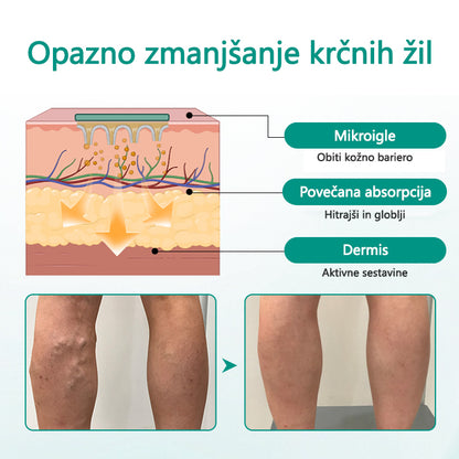 Tainun® LegRenew obliž za krčne žile izboljša zdravje ven in odpravi krčne žile – brez operacije