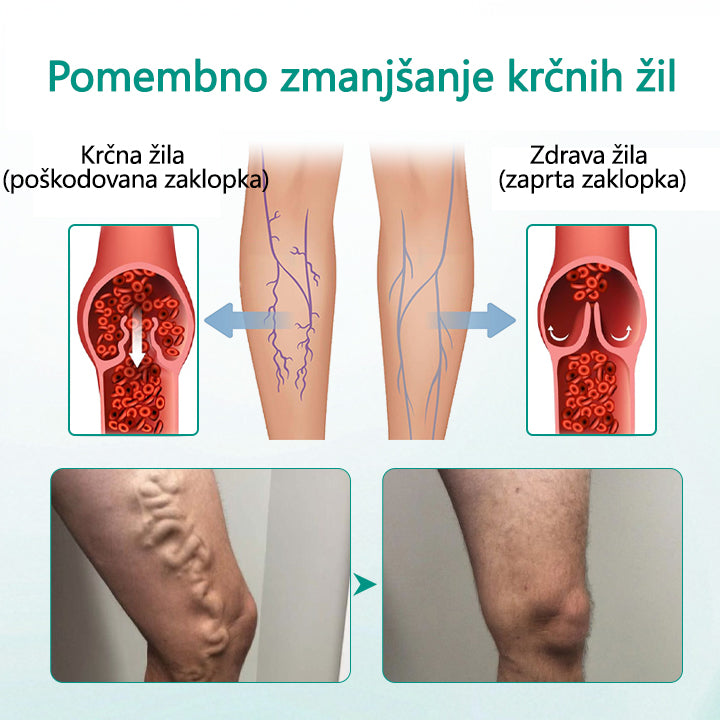 Tainun® LegRenew obliž za krčne žile izboljša zdravje ven in odpravi krčne žile – brez operacije