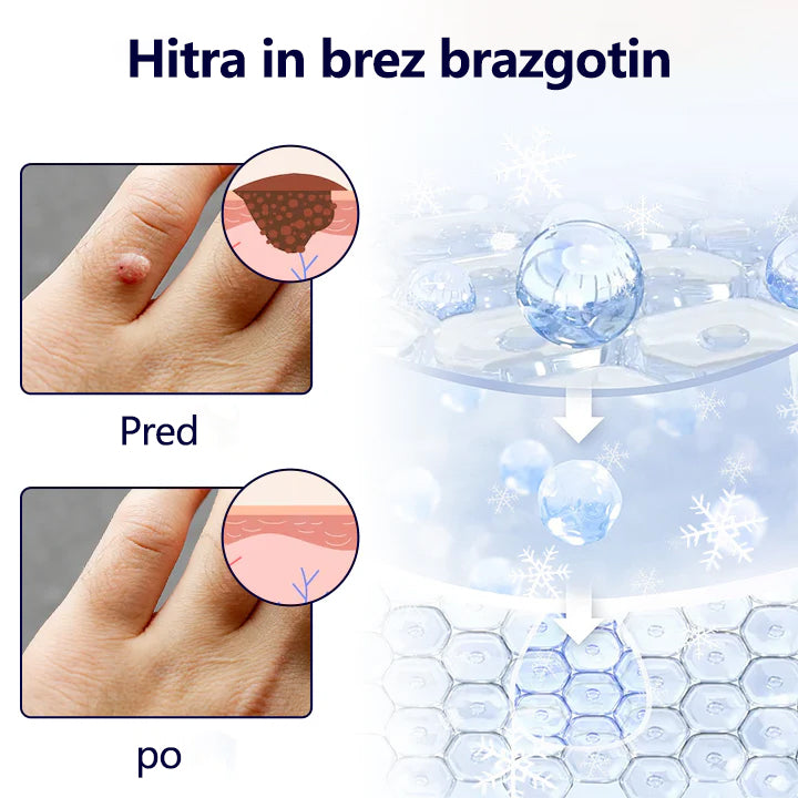 Tainun® ChillErase – spray za obnovo brazgotin po aknah ✨ | Varno odstranjuje kožne oznake, madeže & bradavice doma ✅