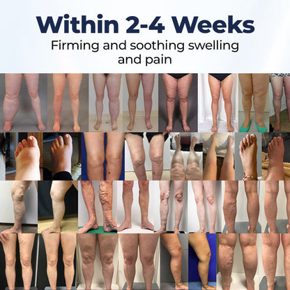 Twisma® SwellRelief krema za podporo prekrvavitvi 👩🏻‍⚕️ POSEBNA RAZPRODAJA – ZADNJI DAN | 80 % POPUST 🔥